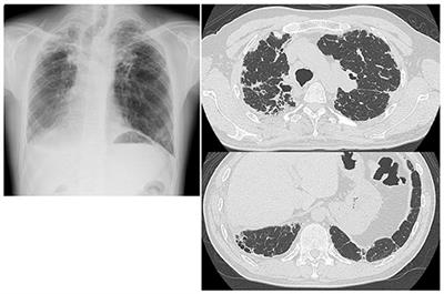 Case Report: Efficacy of Ninjin'yoeito Treatment for Idiopathic Pulmonary Fibrosis